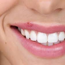 Aïe, un bouton de fièvre ! Que faire ?